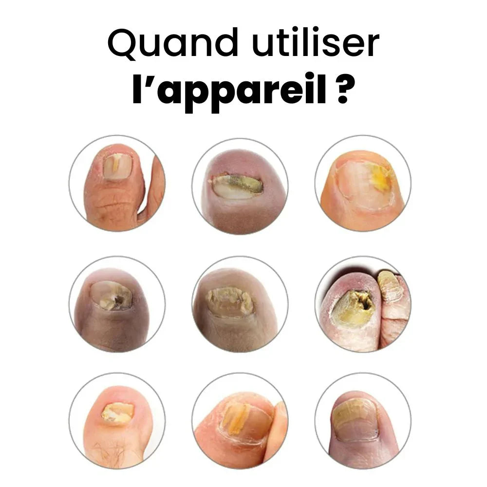 Neta Ongles: Votre Solution Pour Combattre les Mycoses