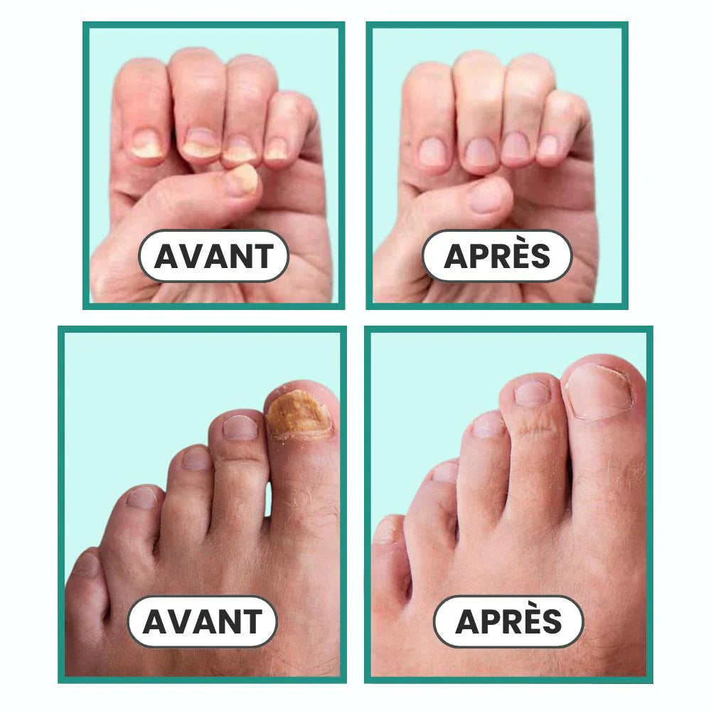 Neta Ongles: Votre Solution Pour Combattre les Mycoses